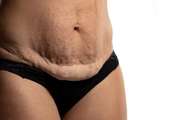 The Science of Skin Tightening 1 The science behind skin tightening Oxford picture of a woman's sagging skin on the stomach